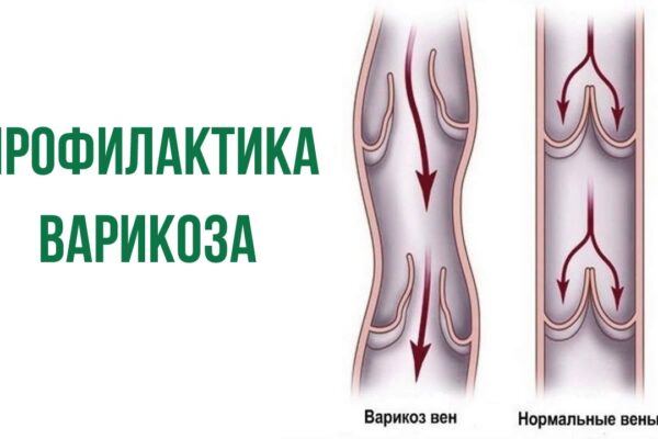 профилактика варикоза